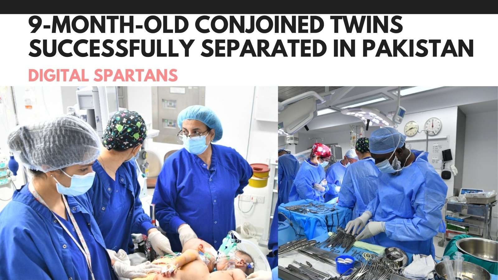 9-Month-Old Conjoined Twins Successfully Separated in Pakistan